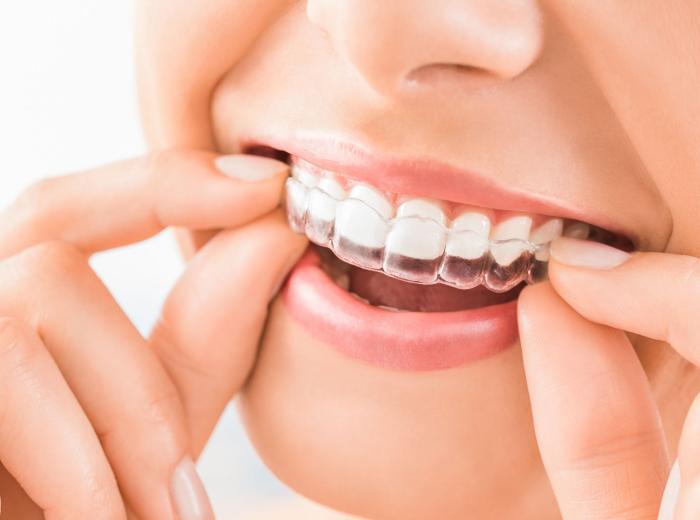 Considering Online Clear Aligners? Read This First