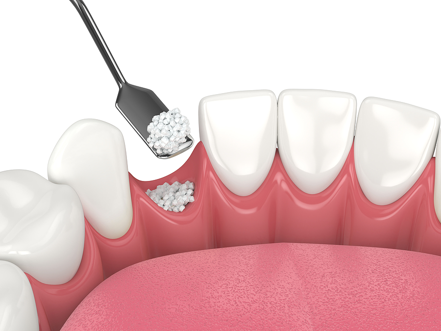 Understanding Bone Grafts: A Vital Procedure for Dental and Oral Health