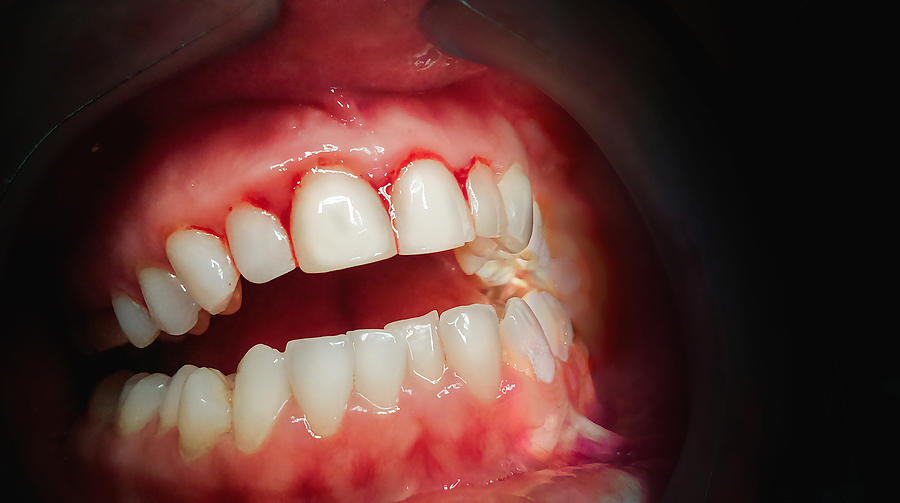 Understanding Gum Disease: Causes, Symptoms, and Treatment Options